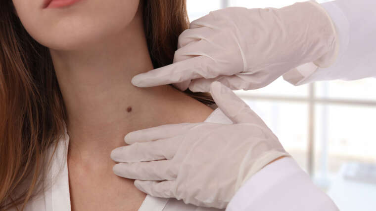 Mole and Wart Removal