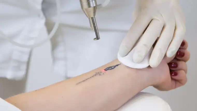Laser Tattoo Removal