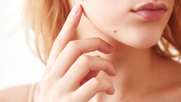How to Prevent Moles and Warts: Tips for Skin Care and Protection