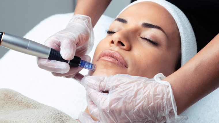 Microneedling for Hyperpigmentation: Effectiveness and Results