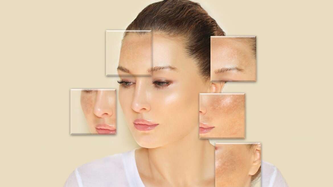 Understanding Pigmentation: Causes, Types, and Advanced Treatment Options at Aura Skin & Laser Clinic, Pune