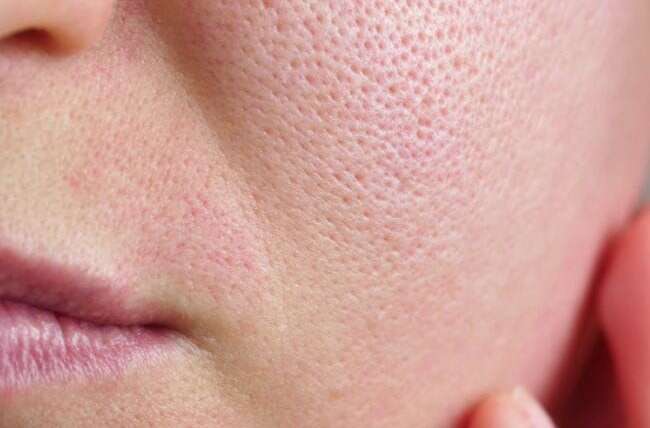 Laser Treatments for Open Pores: Can Pores Actually Get Smaller?