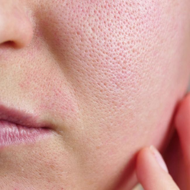 Laser Treatments for Open Pores: Can Pores Actually Get Smaller?
